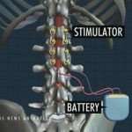 Desarrollan chip eléctrico que hace caminar a paralíticos