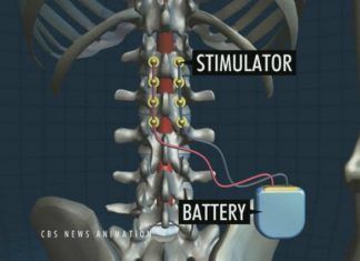 Desarrollan chip eléctrico que hace caminar a paralíticos Desarrollan chip eléctrico que hace caminar a paralíticos