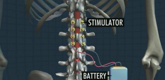 Desarrollan chip eléctrico que hace caminar a paralíticos